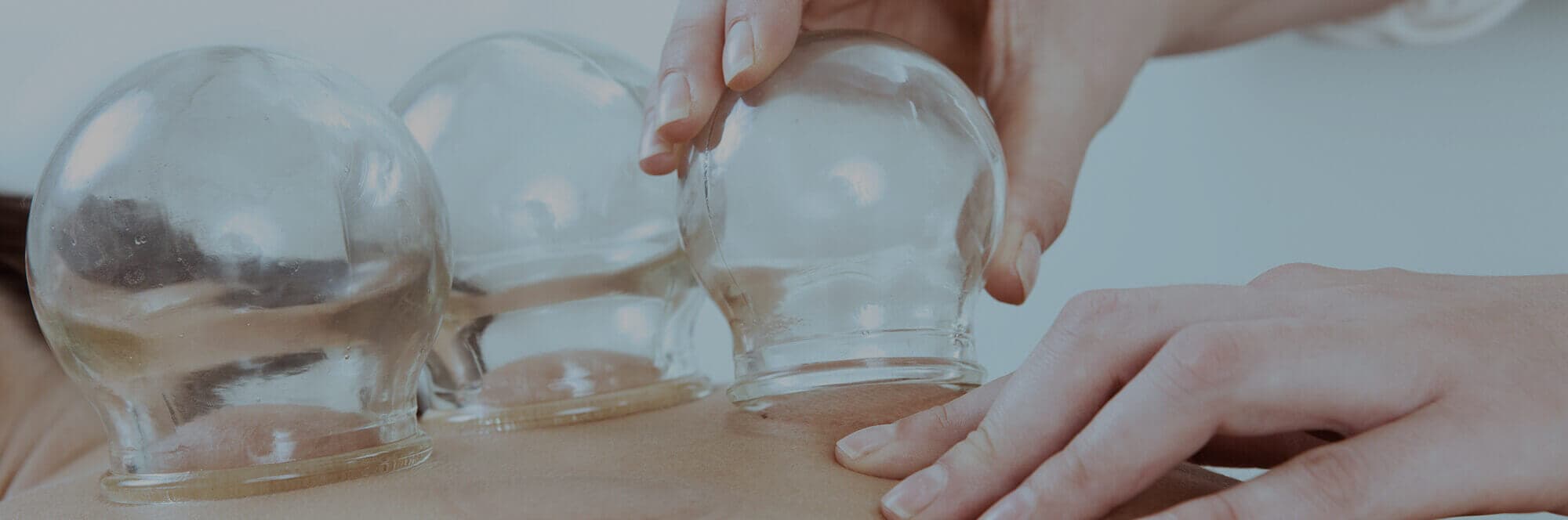 Cupping Therapy Treatment